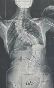 radiografiaAS500 correttivo al codice - radiografia spina dorsale